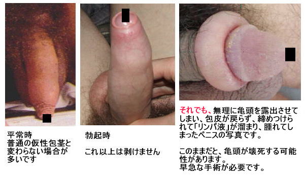 カントン包茎画像